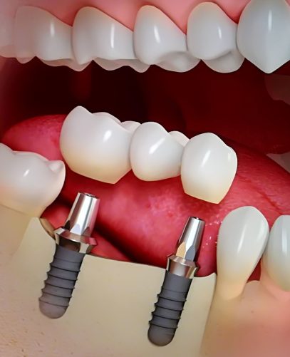 centro odontológico implantes